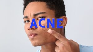 Acne: Causes, Treatment, and Effective Care